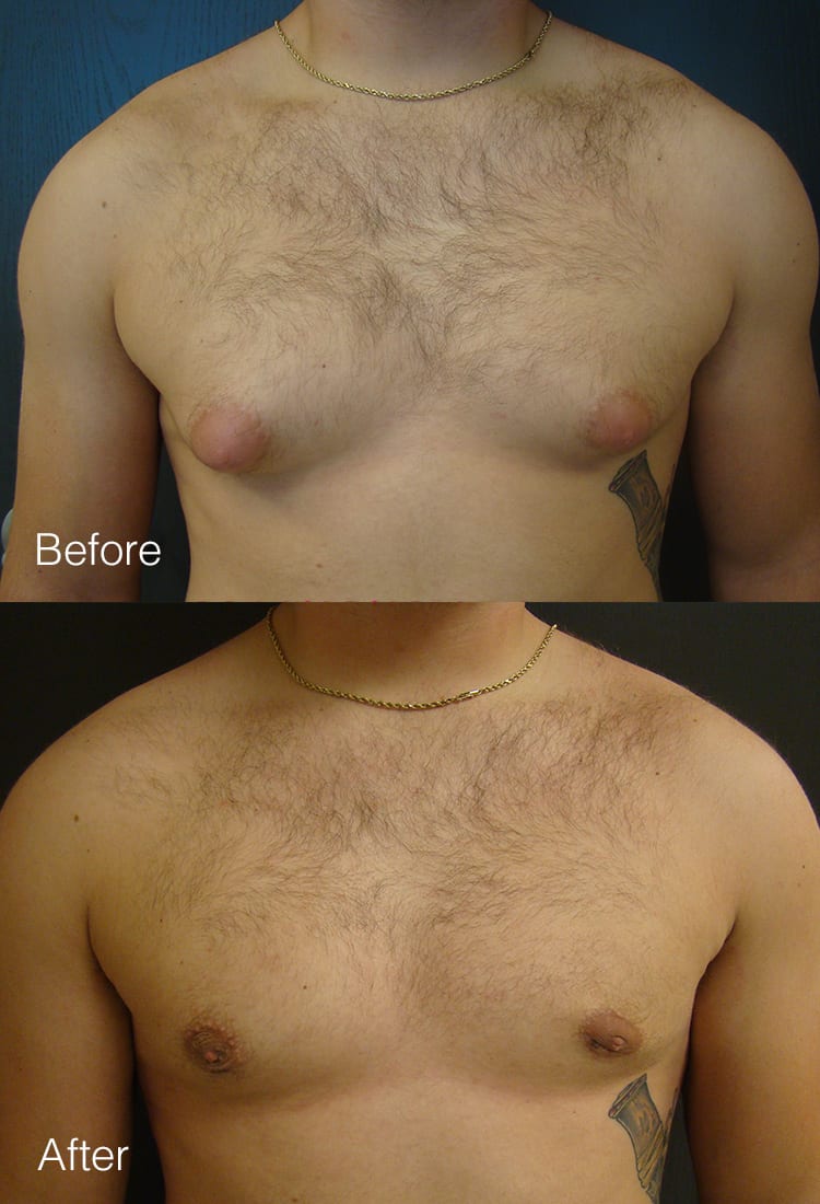 Male Breast Reduction - Before & After