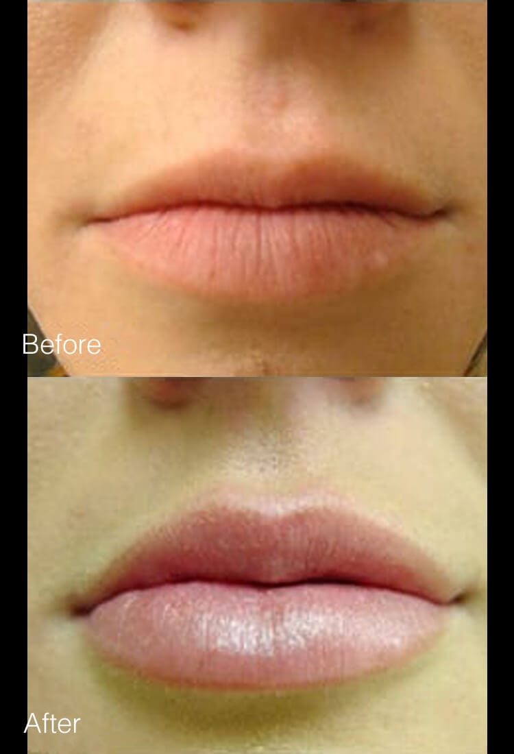 Lip Augmentation - Before & After