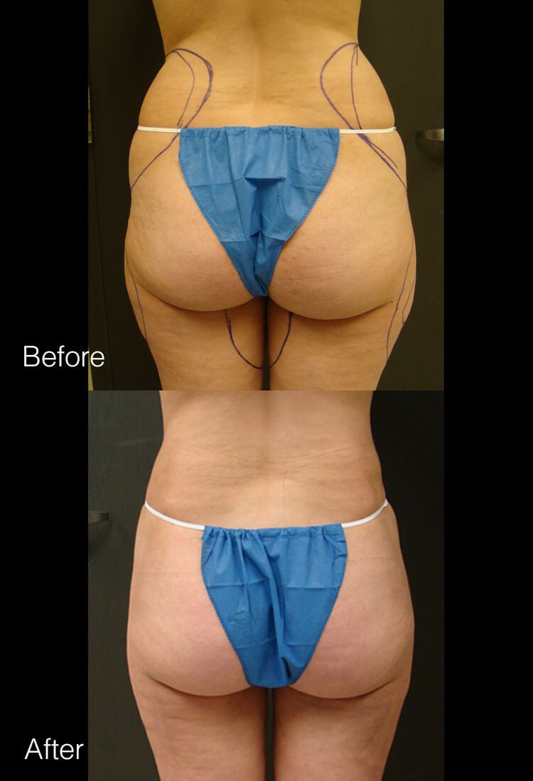 Liposuction - Before & After