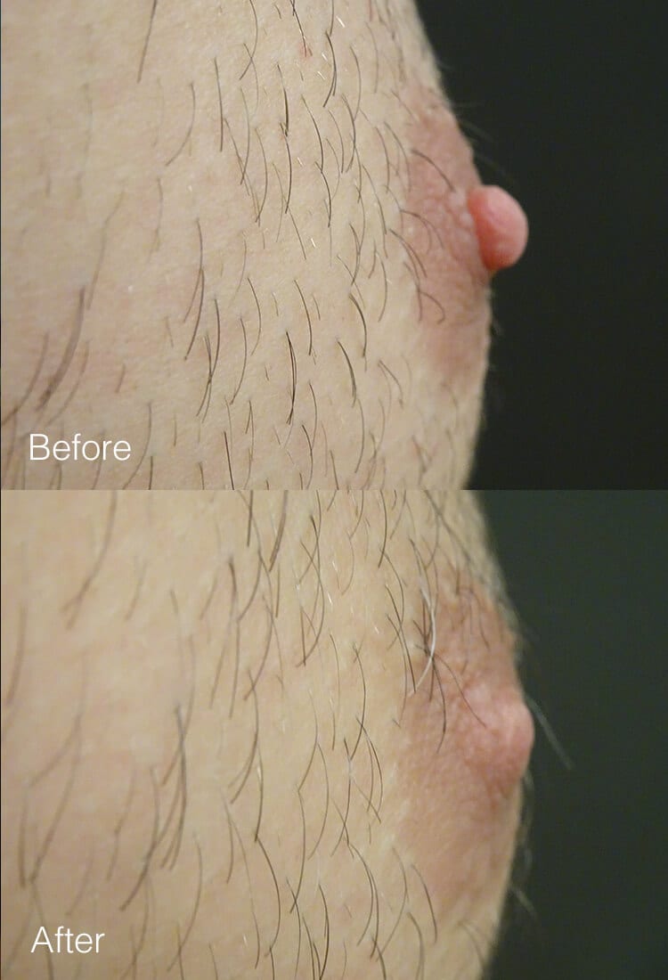 Male Nipple Reduction - Before & After