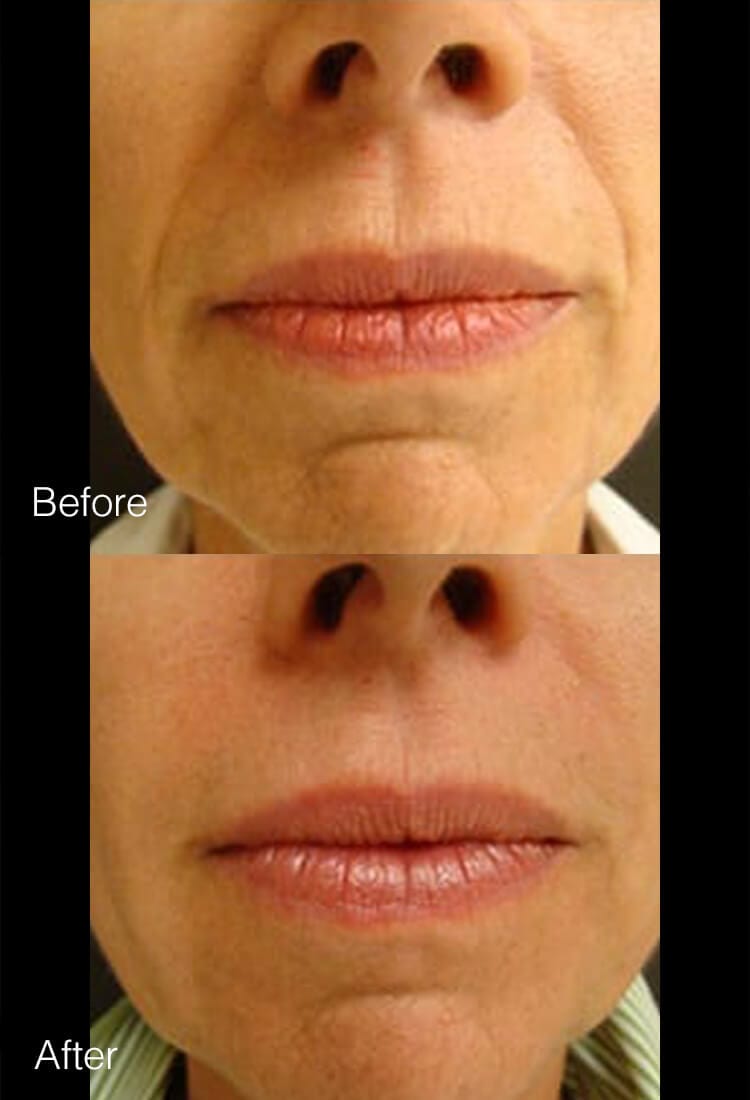 Restylane & Juvederm - Before & After