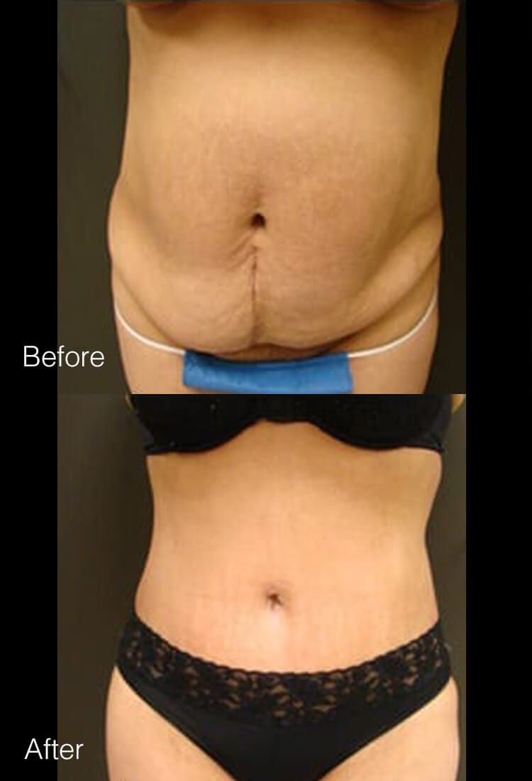Tummy tuck - Before & After