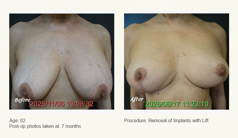 Breast Implant Removal - Patient 1