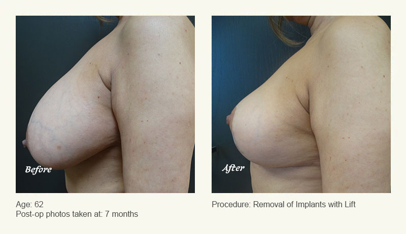 Breast Implant Removal - Patient 2
