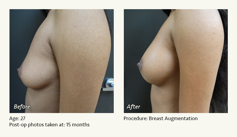 Breast Augmentation in Plano, TX - Patient 2