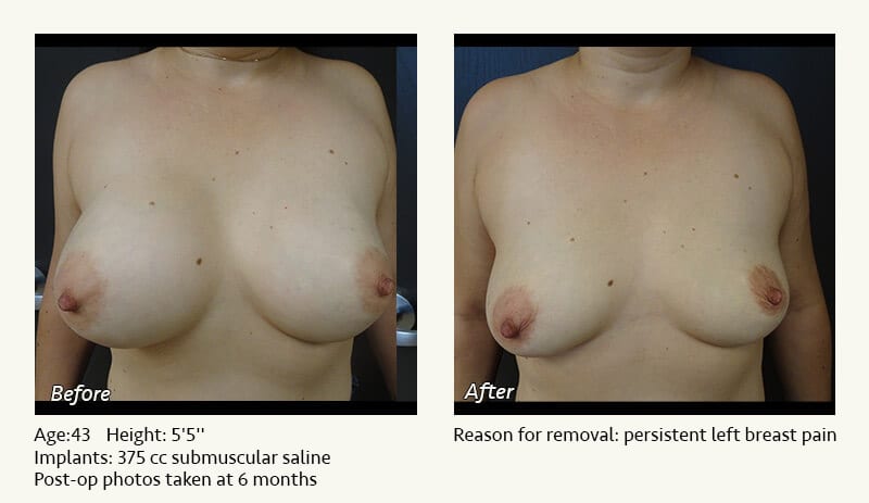 Breast Implant Removal - Patient 9