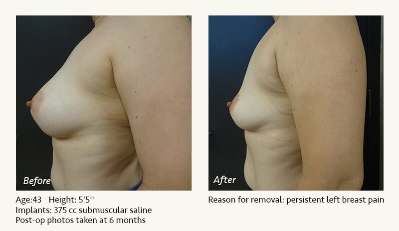 Breast Implant Removal - Patient 10