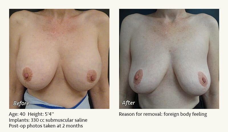 Breast Implant Removal - Patient 11
