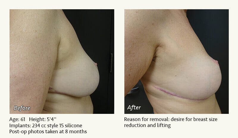 Breast Implant Removal - Patient 20