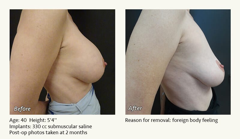 Breast Implant Removal - Patient 12