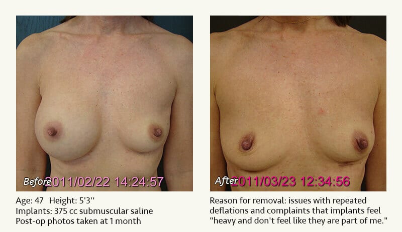 Breast Implant Removal - Patient 13