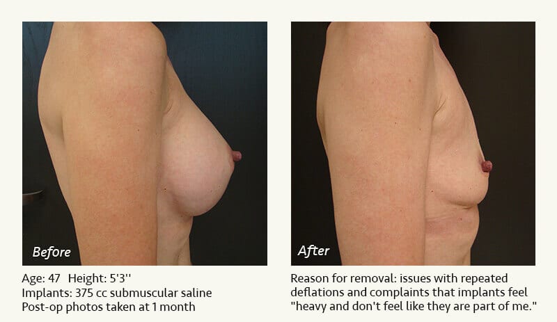 Breast Implant Removal - Patient 14