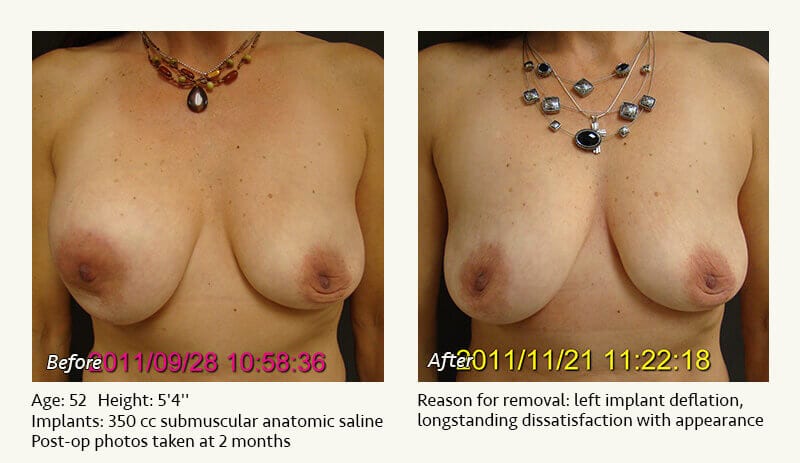 Breast Implant Removal - Patient 15