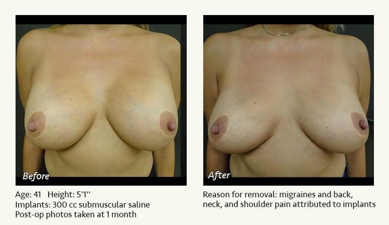 Breast Implant Removal - Patient 17