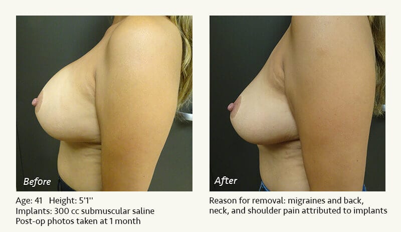 Breast Implant Removal - Patient 18