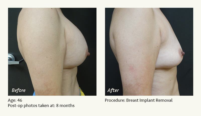 Breast Implant Removal - Patient 2