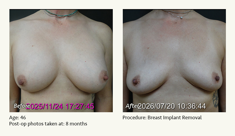Breast Implant Removal - Patient 1