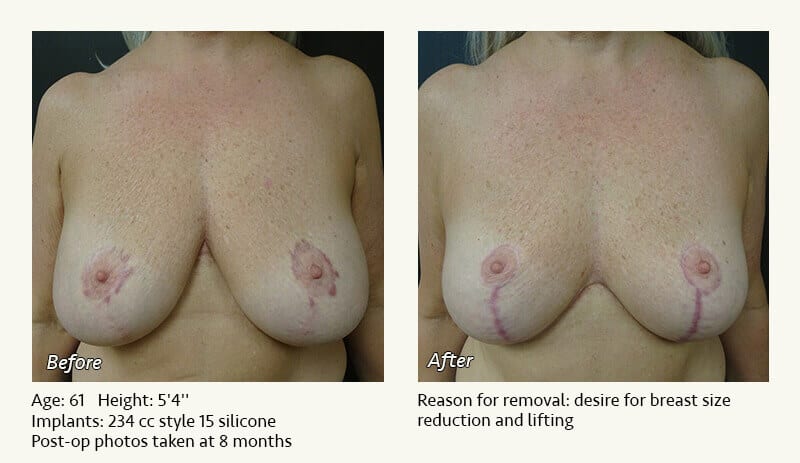 Breast Implant Removal - Patient 19