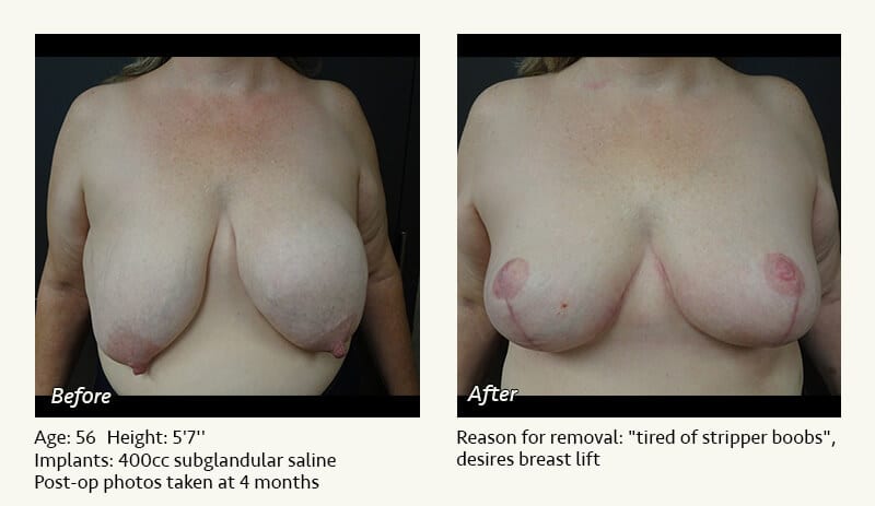 Breast Implant Removal - Patient 7