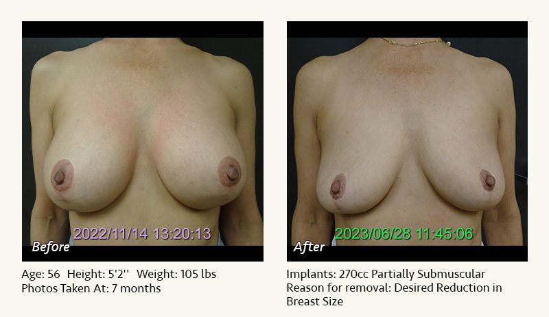 Breast Implant Removal - Patient 5