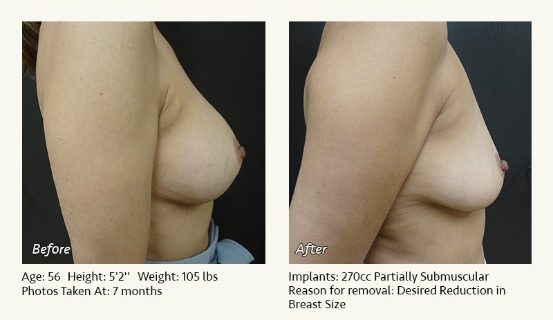 Breast Implant Removal - Patient 6