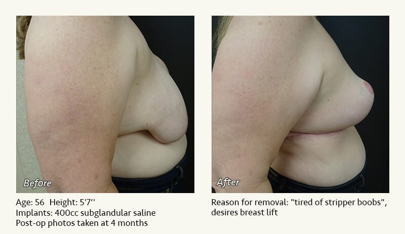 Breast Implant Removal - Patient 8