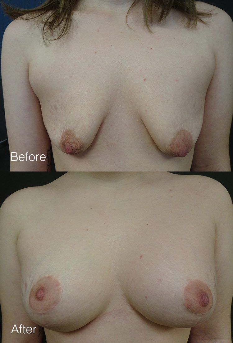 Breast Augmentation with Breast Lift - Before & After