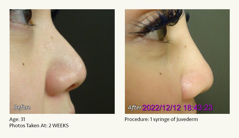 Nonsurgical Rhinoplasty in Plano & Dallas, TX - Patient 4