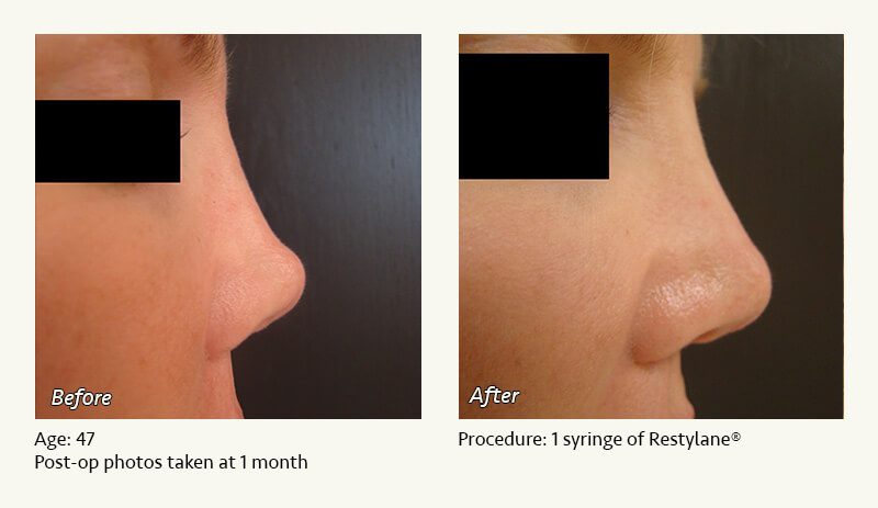 Nonsurgical Rhinoplasty in Plano & Dallas, TX - Patient 7