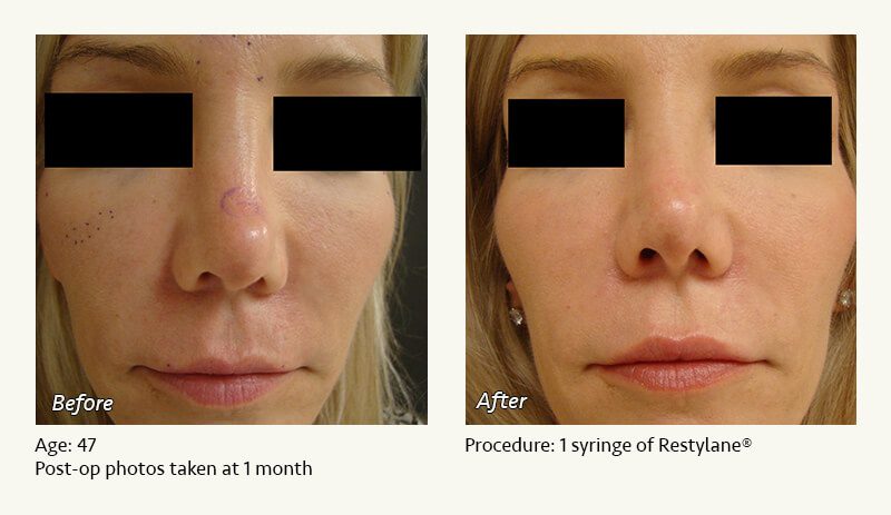 Nonsurgical Rhinoplasty in Plano & Dallas, TX - Patient 6