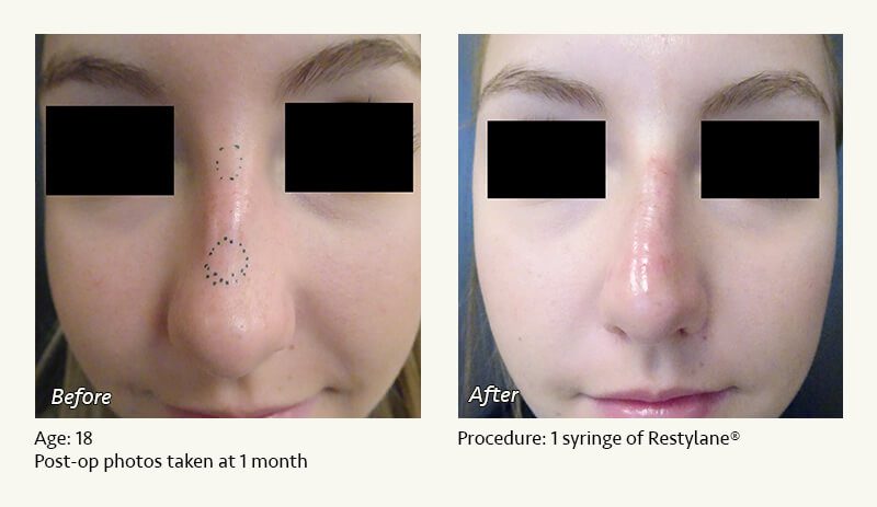 Nonsurgical Rhinoplasty in Plano & Dallas, TX - Patient 8
