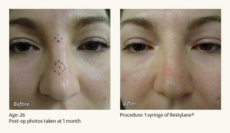 Nonsurgical Rhinoplasty in Plano & Dallas, TX - Patient 10