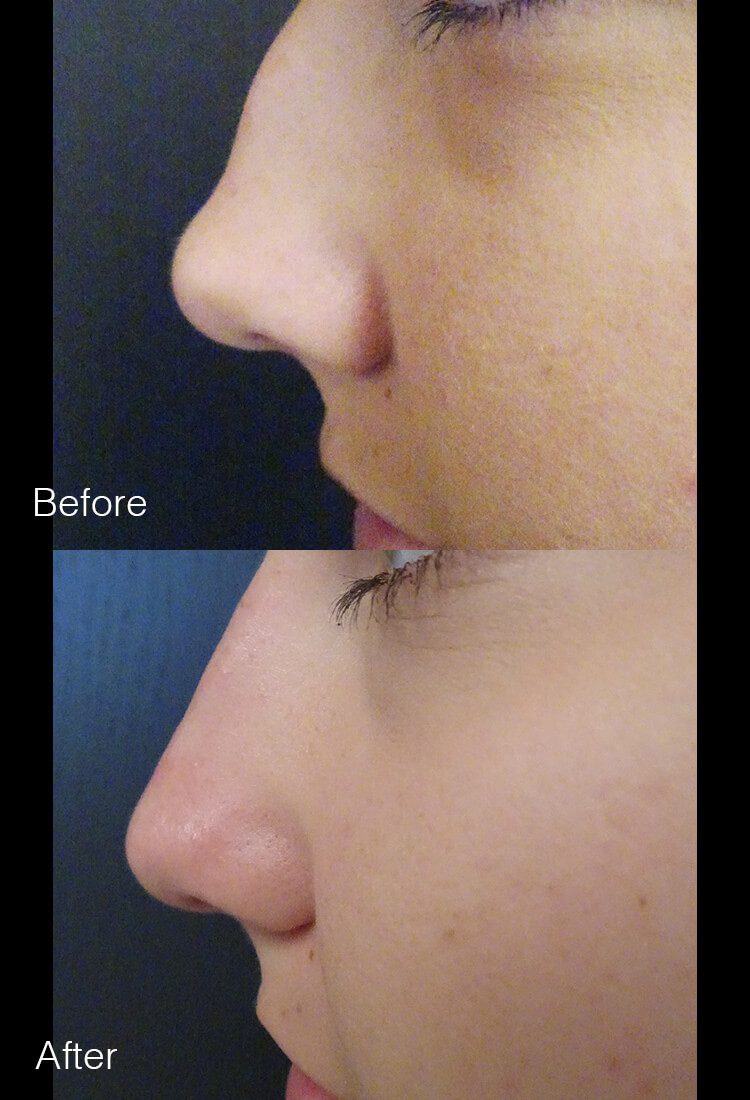 Nonsurgical Rhinoplasty - Before & After