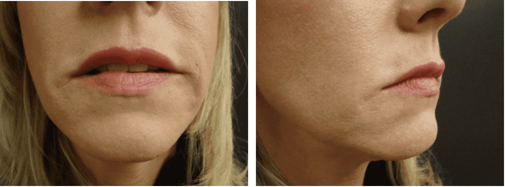 Patient after receiving Restylane facial filler