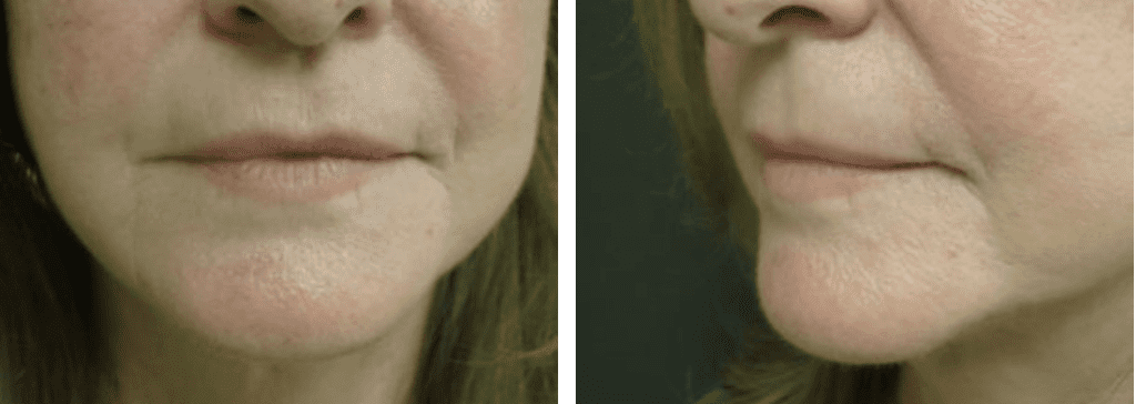 Patient's face after receiving Restylane® injectable filler