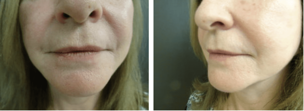 Patient before receiving Restylane® injectable filler