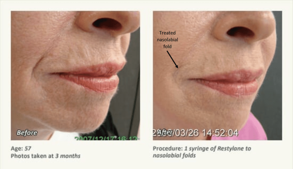 Nasolabial fold treatment