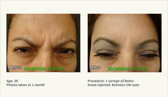 Botox Patient results 2