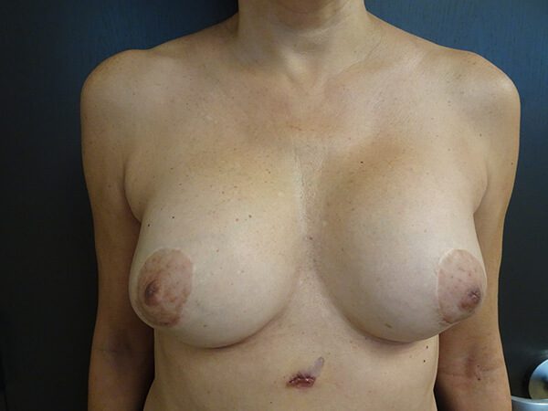 Periareolar Breast Lift After