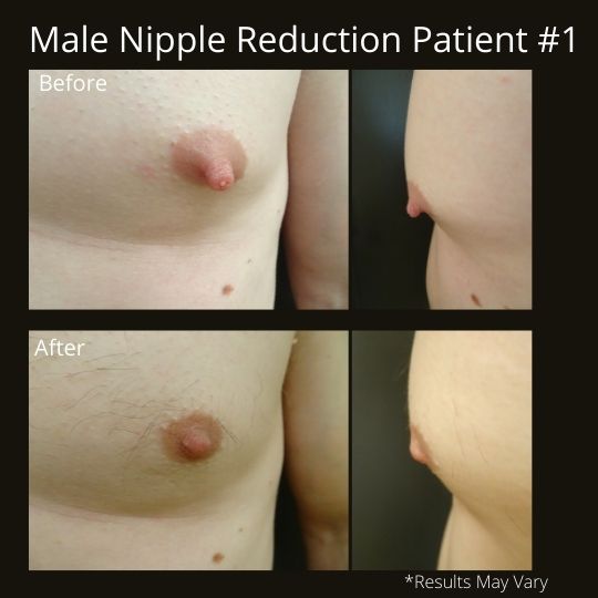Before and after image showing the results of a male nipple reduction candidate.