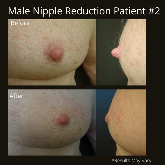 Before and after image of a male nipple reduction patient. 