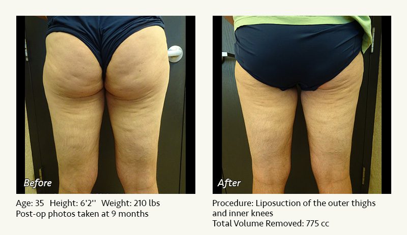 Male Liposuction Surgery - Patient 10