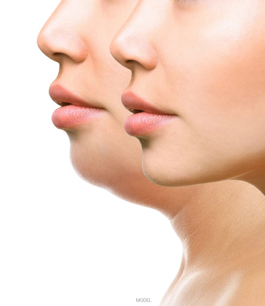 Before and after chin fat removal treatment.