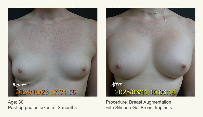 Breast Augmentation in Plano, TX - Patient 5