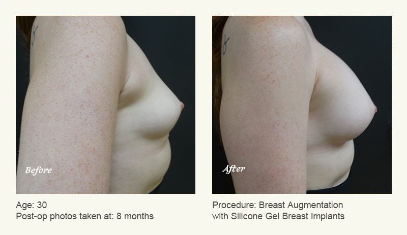 Breast Augmentation in Plano, TX - Patient 6