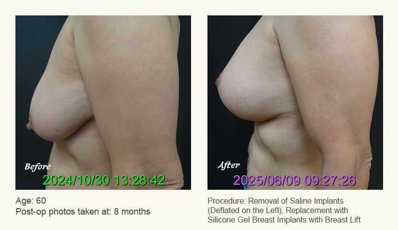 Breast Implant Revision in Plano, TX - Patient 2