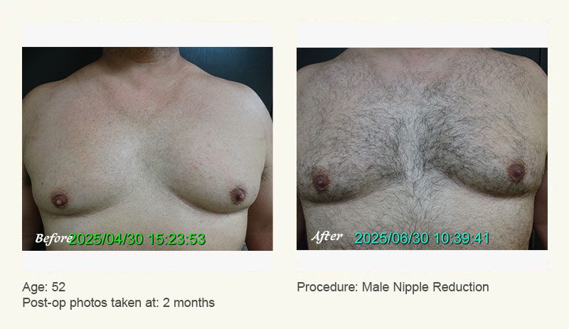 Male Nipple Reduction in Plano, TX - Patient 1