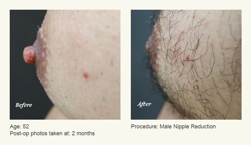 Male Nipple Reduction in Plano, TX - Patient 2