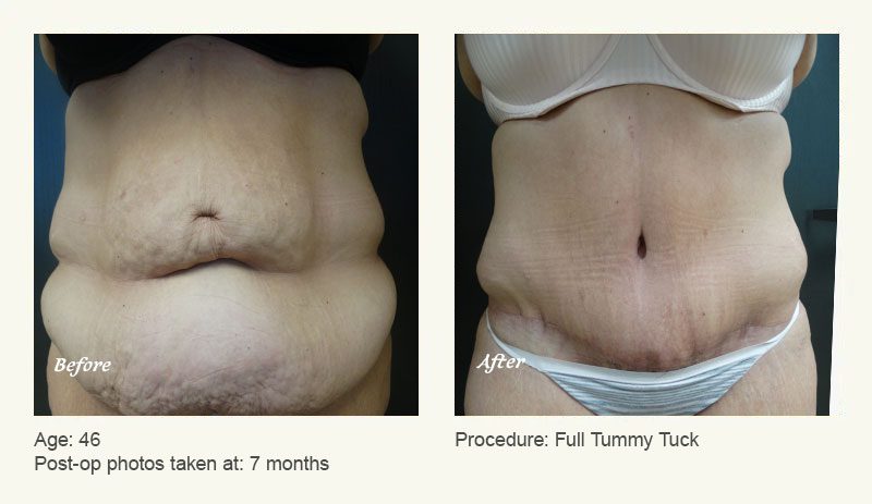 Tummy Tuck in Plano, TX - Patient 5