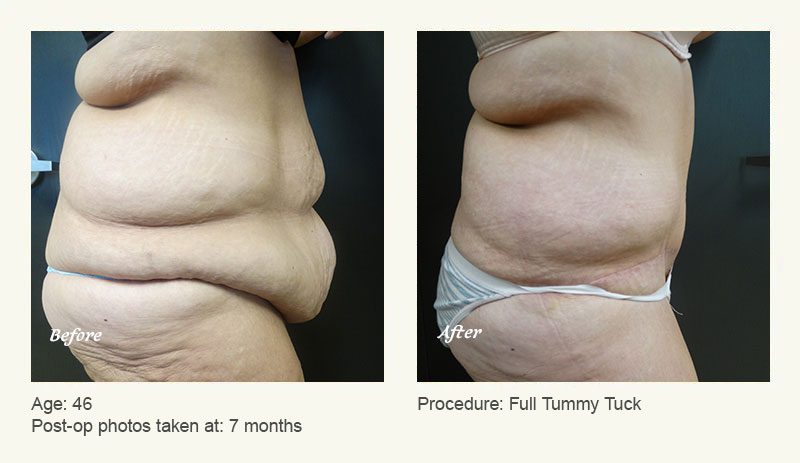 Tummy Tuck in Plano, TX - Patient 6